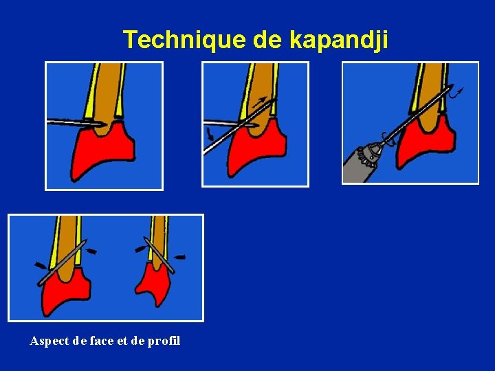 Technique de kapandji Aspect de face et de profil 