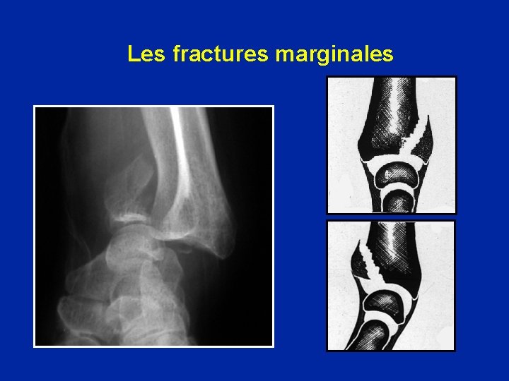 Les fractures marginales 