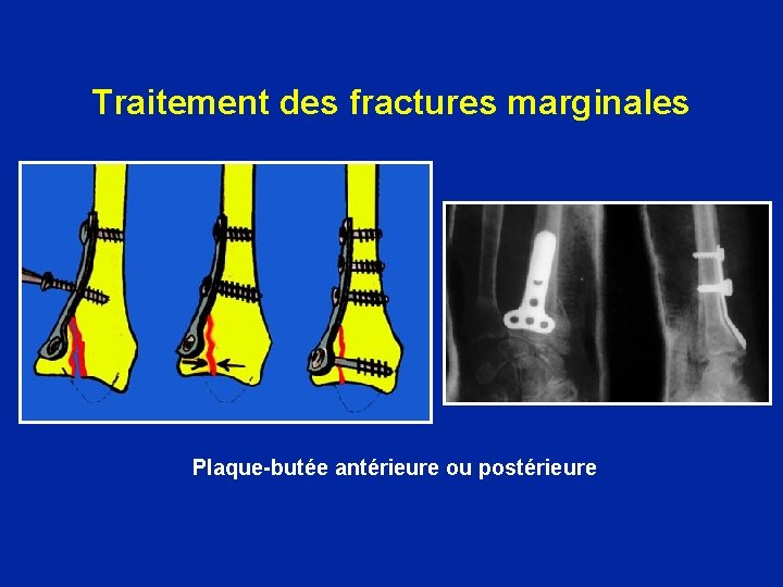 Traitement des fractures marginales Plaque-butée antérieure ou postérieure 