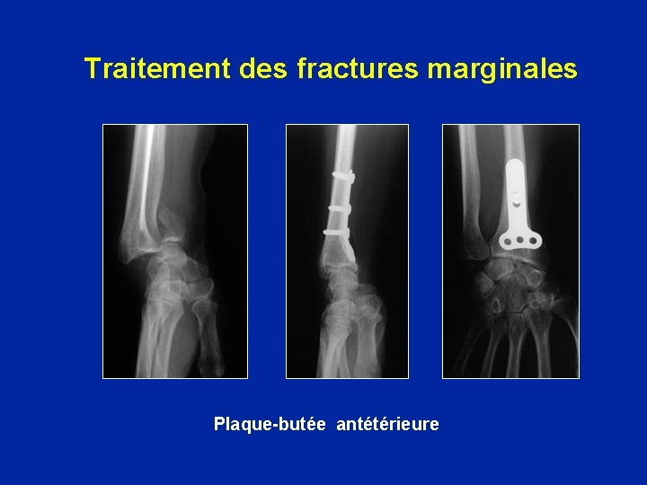 Traitement des fractures marginales Plaque-butée antétérieure 