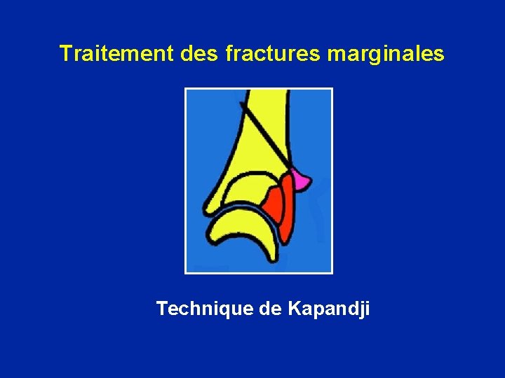 Traitement des fractures marginales Technique de Kapandji 