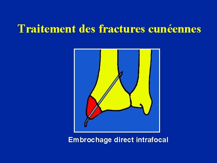 Traitement des fractures cunéennes Embrochage direct intrafocal 