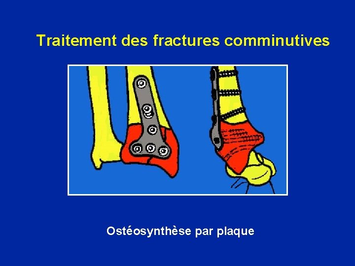 Traitement des fractures comminutives Ostéosynthèse par plaque 