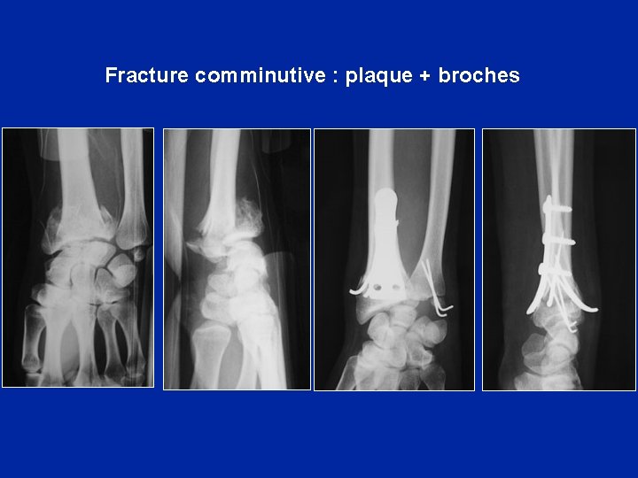 Fracture comminutive : plaque + broches 