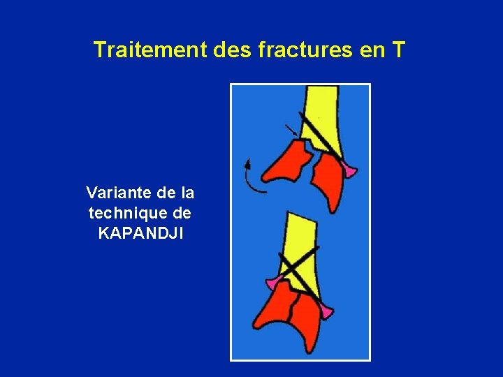 Traitement des fractures en T Variante de la technique de KAPANDJI 