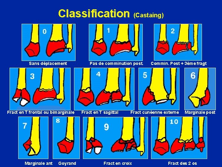 Classification (Castaing) Sans déplacement Pas de comminution post. Commin. Post + 3ème fragt Fract