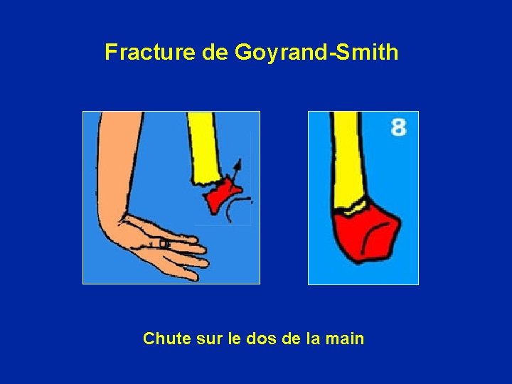 Fracture de Goyrand-Smith Chute sur le dos de la main 