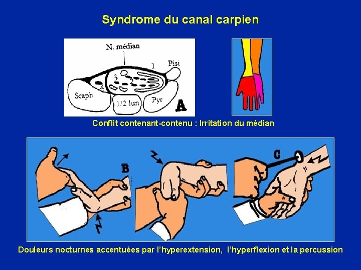 Syndrome du canal carpien Conflit contenant-contenu : Irritation du médian Douleurs nocturnes accentuées par
