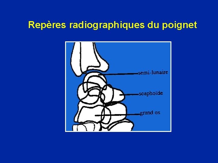Repères radiographiques du poignet 