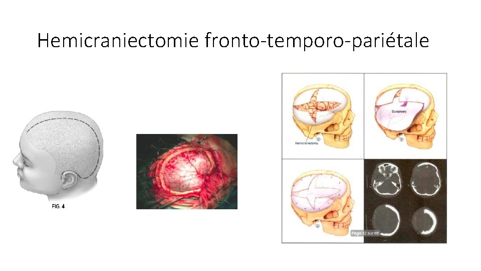 Hemicraniectomie fronto-temporo-pariétale 