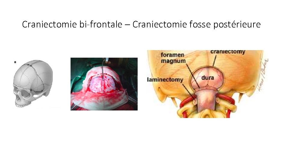 Craniectomie bi-frontale – Craniectomie fosse postérieure 