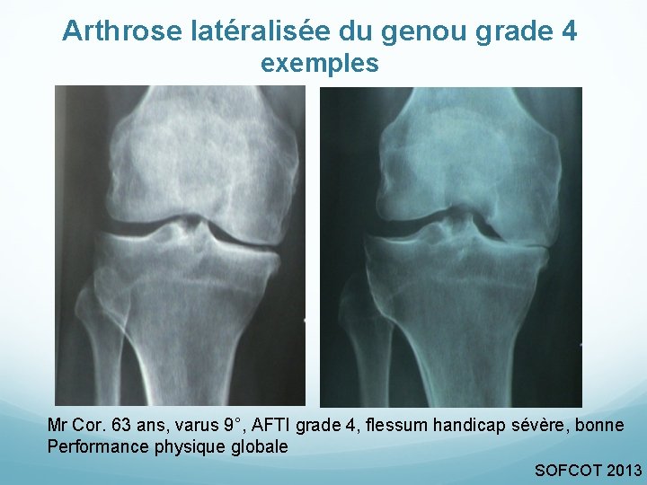 Arthrose latéralisée du genou grade 4 exemples Mr Cor. 63 ans, varus 9°, AFTI Arthrose latéralisée du genou grade 4 exemples Mr Cor. 63 ans, varus 9°, AFTI