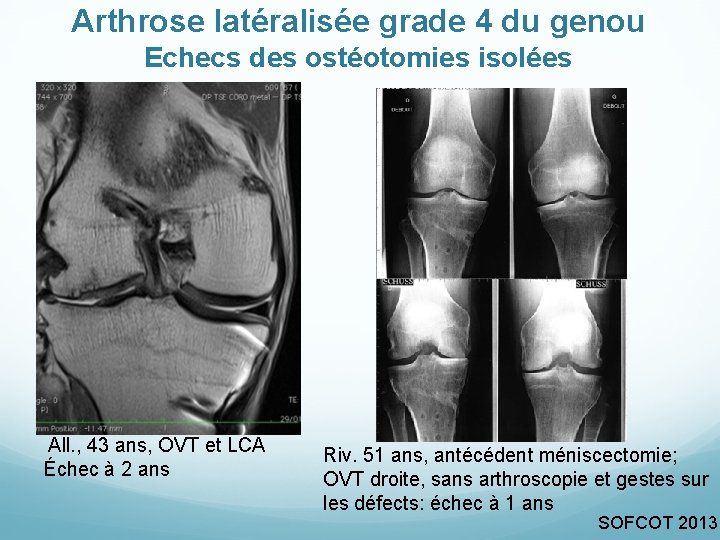 Arthrose latéralisée grade 4 du genou Echecs des ostéotomies isolées All. , 43 ans,