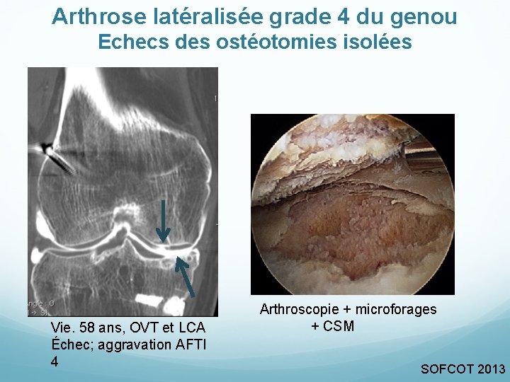 Arthrose latéralisée grade 4 du genou Echecs des ostéotomies isolées Vie. 58 ans, OVT