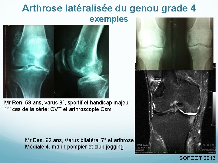 Arthrose latéralisée du genou grade 4 exemples Mr Ren. 58 ans, varus 8°, sportif