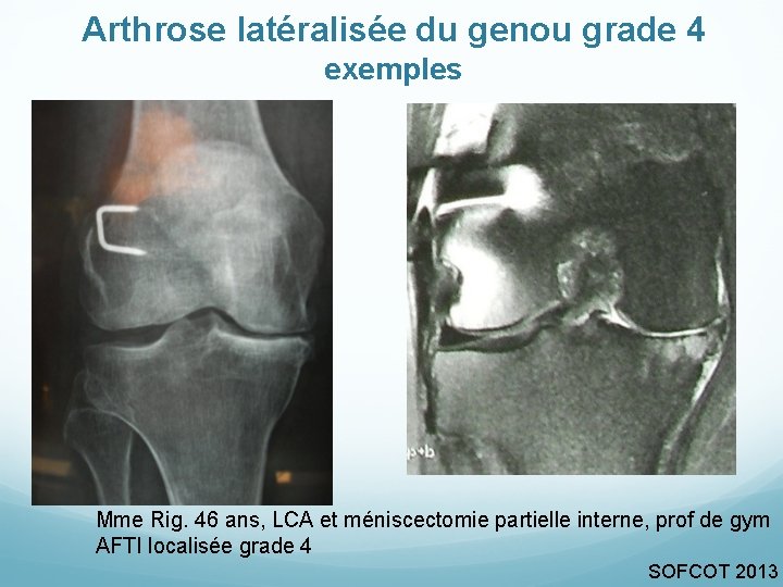 Arthrose latéralisée du genou grade 4 exemples Mme Rig. 46 ans, LCA et méniscectomie