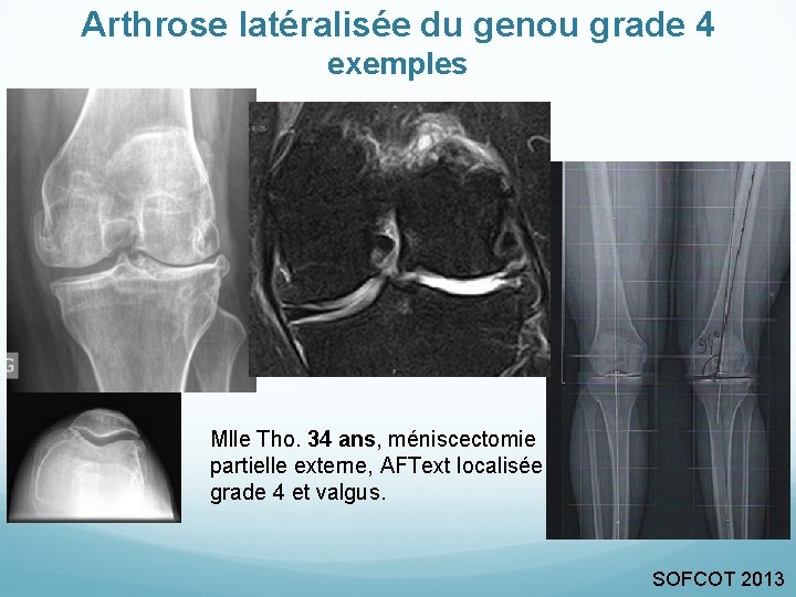 Arthrose latéralisée du genou grade 4 exemples Mlle Tho. 34 ans, méniscectomie partielle externe,