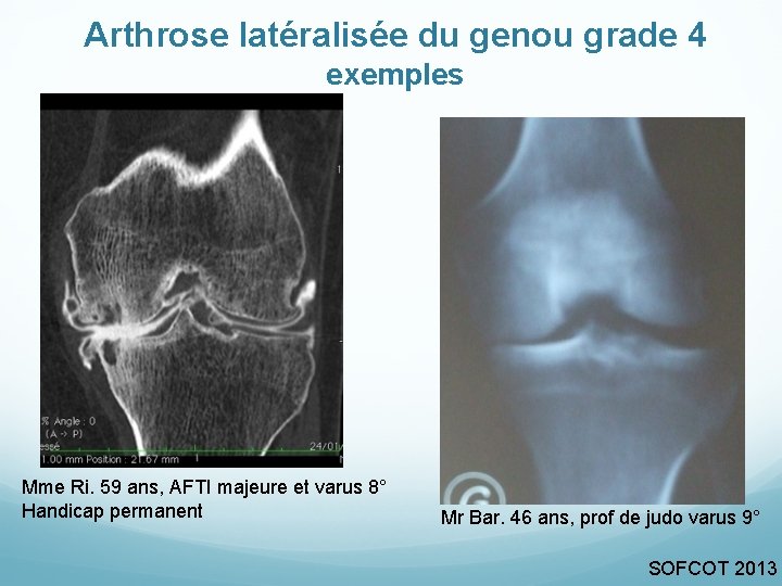Arthrose latéralisée du genou grade 4 exemples Mme Ri. 59 ans, AFTI majeure et