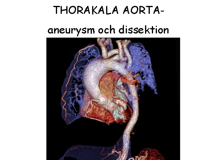 THORAKALA AORTAaneurysm och dissektion 