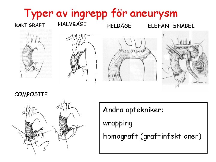 Typer av ingrepp för aneurysm RAKT GRAFT HALVBÅGE HELBÅGE ELEFANTSNABEL COMPOSITE Andra optekniker: wrapping