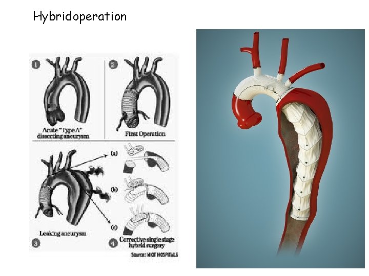 Hybridoperation 