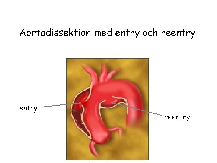 Aortadissektion med entry och reentry 