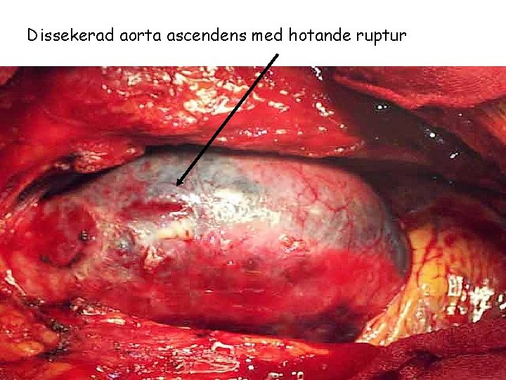 Dissekerad aorta ascendens med hotande ruptur 