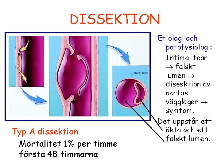 DISSEKTION Typ A dissektion Mortalitet 1% per timme första 48 timmarna Etiologi och patofysiologi: