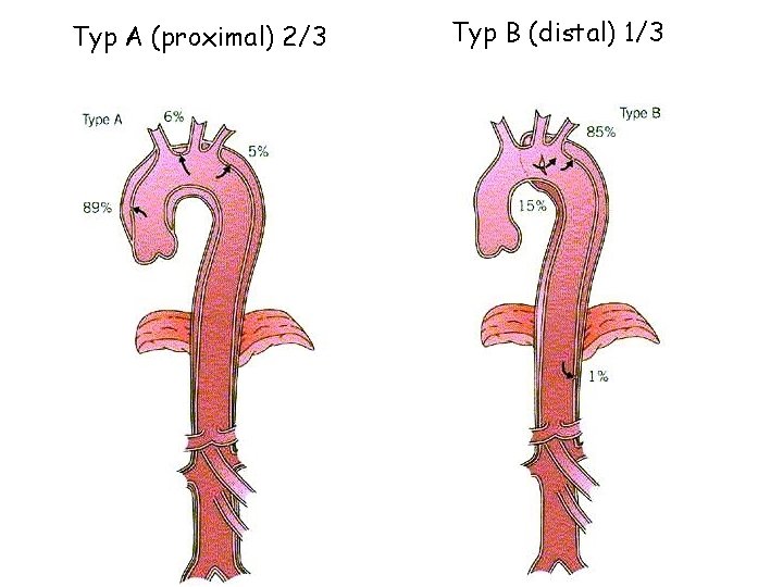 Typ A (proximal) 2/3 Typ B (distal) 1/3 