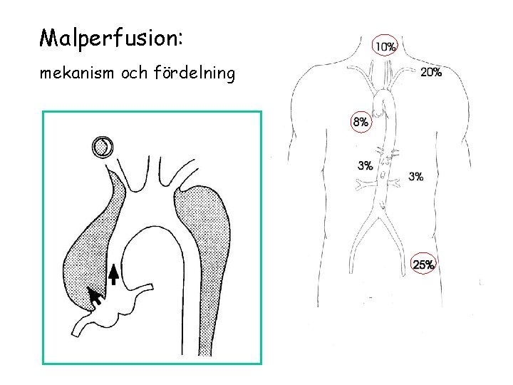 Malperfusion: mekanism och fördelning 