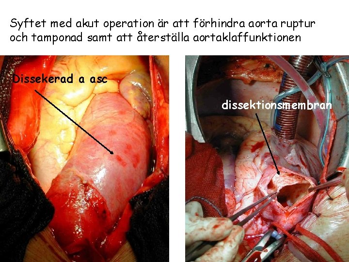 Syftet med akut operation är att förhindra aorta ruptur och tamponad samt att återställa