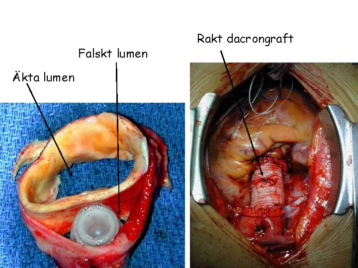 Falskt lumen Äkta lumen Rakt dacrongraft 