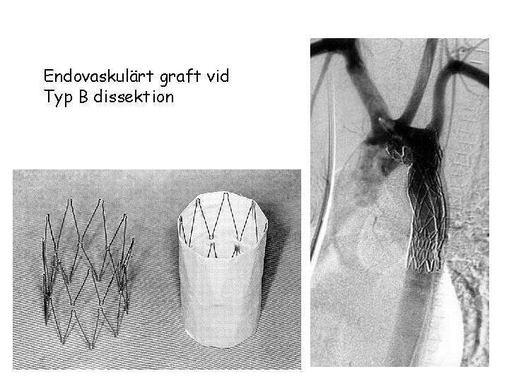 Endovaskulärt graft vid Typ B dissektion 