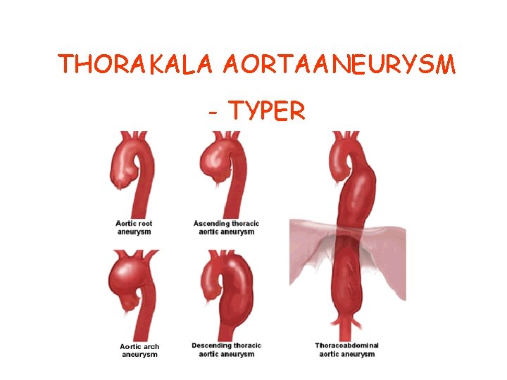 THORAKALA AORTAANEURYSM - TYPER 