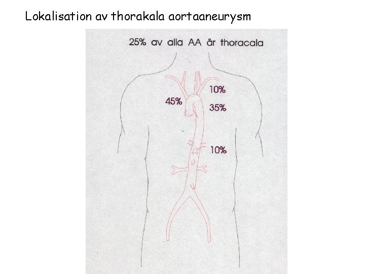 Lokalisation av thorakala aortaaneurysm 