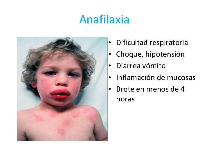 Anafilaxia • • • Dificultad respiratoria Choque, hipotensión Diarrea vómito Inflamación de mucosas Brote