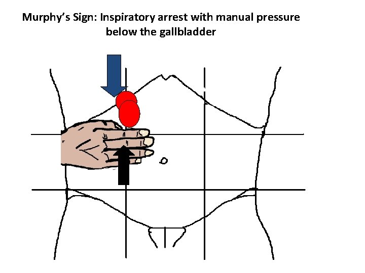 Murphy’s Sign: Inspiratory arrest with manual pressure below the gallbladder 