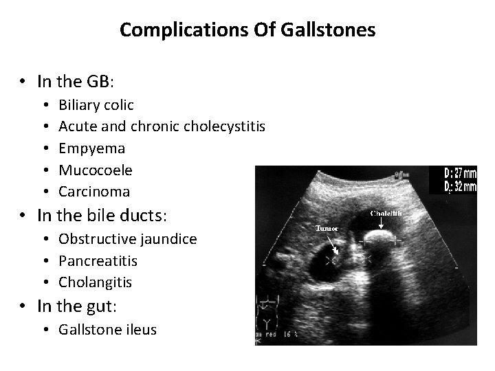 Complications Of Gallstones • In the GB: • • • Biliary colic Acute and