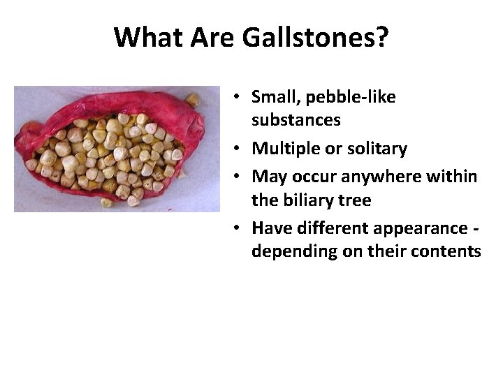 What Are Gallstones? • Small, pebble-like substances • Multiple or solitary • May occur