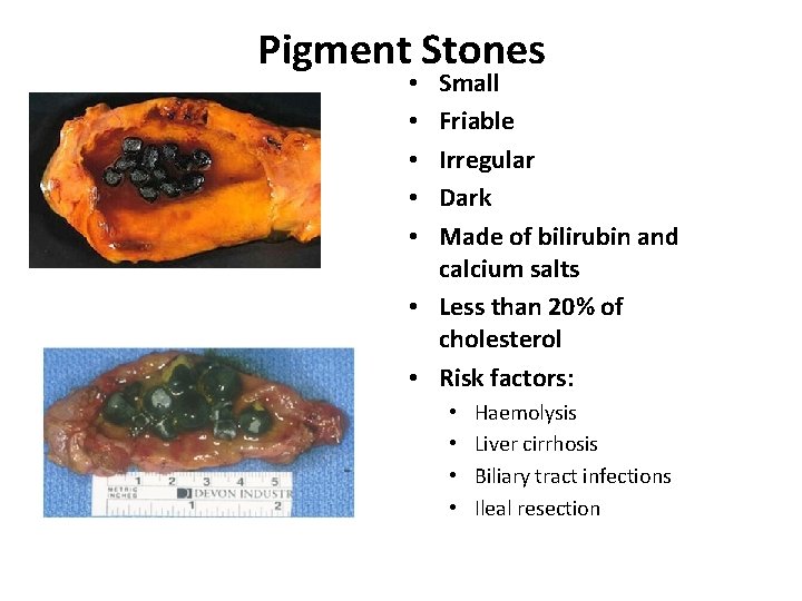 Pigment Stones Small Friable Irregular Dark Made of bilirubin and calcium salts • Less