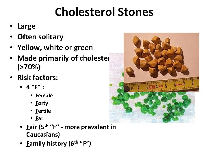 Cholesterol Stones Large Often solitary Yellow, white or green Made primarily of cholesterol (>70%)