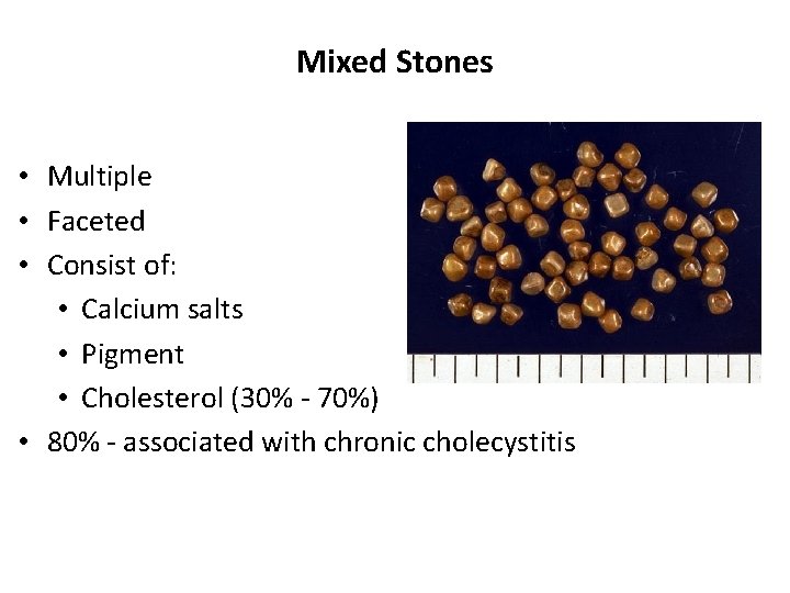 Mixed Stones • Multiple • Faceted • Consist of: • Calcium salts • Pigment