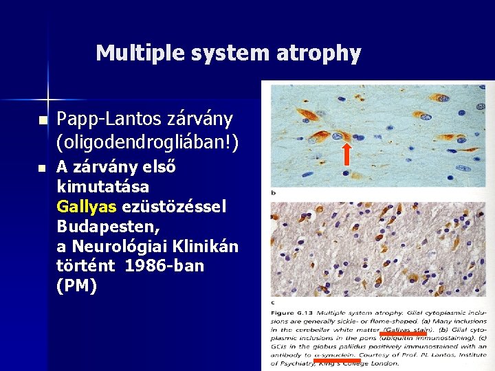 Multiple system atrophy n n Papp-Lantos zárvány (oligodendrogliában!) A zárvány első kimutatása Gallyas ezüstözéssel