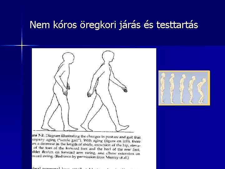 Nem kóros öregkori járás és testtartás 