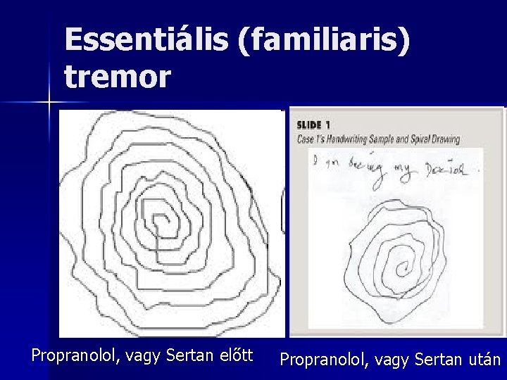 Essentiális (familiaris) tremor Propranolol, vagy Sertan előtt Propranolol, vagy Sertan után 