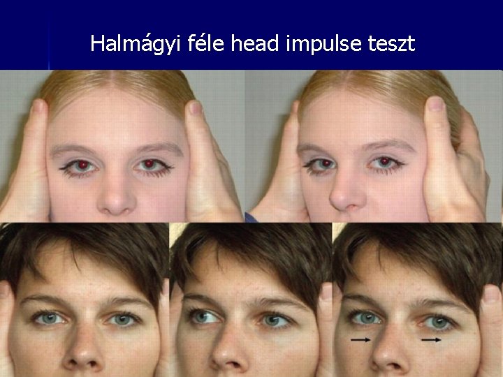 Halmágyi féle head impulse teszt 