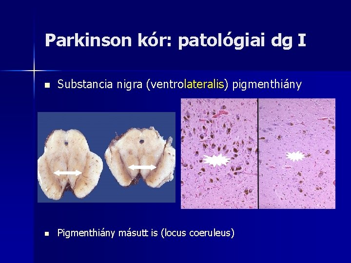 Parkinson kór: patológiai dg I n Substancia nigra (ventrolateralis) pigmenthiány n Pigmenthiány másutt is