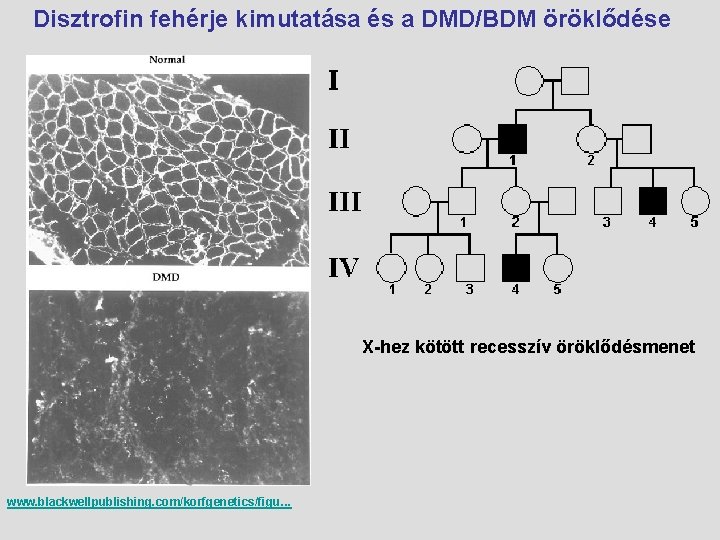 Disztrofin fehérje kimutatása és a DMD/BDM öröklődése X-hez kötött recesszív öröklődésmenet www. blackwellpublishing. com/korfgenetics/figu.