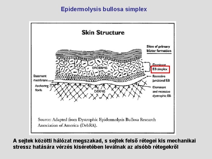 Epidermolysis bullosa simplex A sejtek közötti hálózat megszakad, s sejtek felső rétegei kis mechanikai