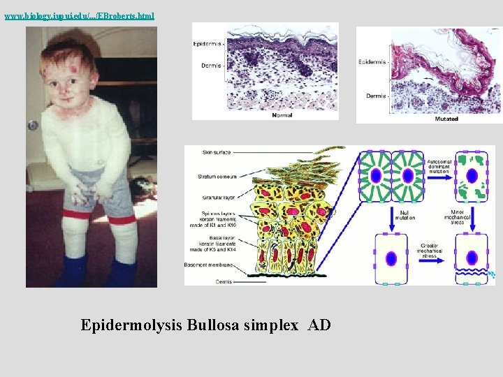 www. biology. iupui. edu/. . . /EBroberts. html Epidermolysis Bullosa simplex AD 